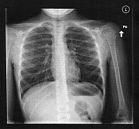 Front X-ray